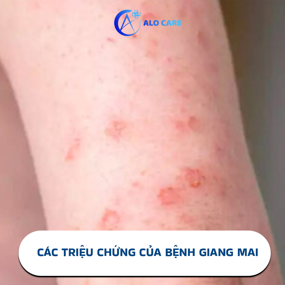 Các triệu chứng của bệnh giang mai